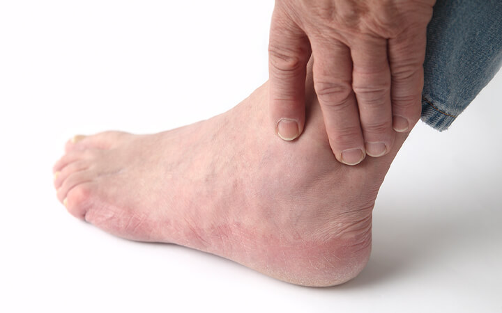 Ankle Arthritis