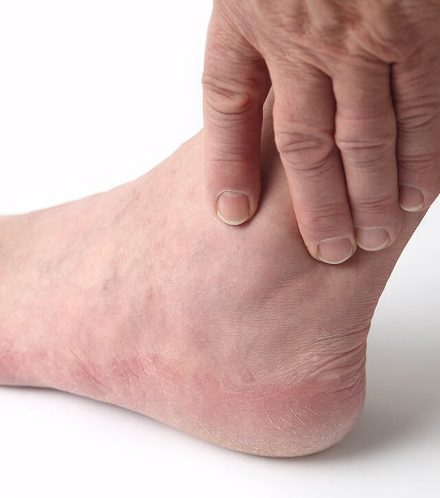 Ankle Arthritis