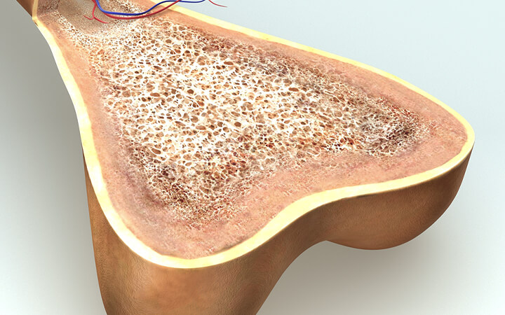 Bone Marrow Lesions