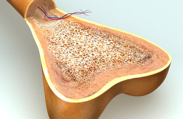 Bone Marrow Lesions (BMLs)